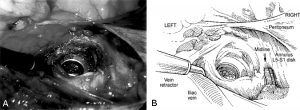 The Laparoscopic Approach for Instrumentation and Fusion of the Lumbar Spine Figure 17