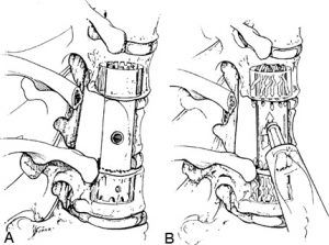 Thoracoscopic Approaches for the Treatment of Anterior Thoracic Spinal Pathology Figure 17