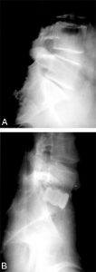 The Laparoscopic Approach for Instrumentation and Fusion of the Lumbar Spine Figure 18
