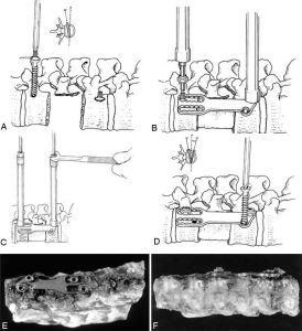 Thoracoscopic Approaches for the Treatment of Anterior Thoracic Spinal Pathology Figure 18
