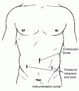 The Laparoscopic Approach for Instrumentation and Fusion of the Lumbar Spine Figure 2