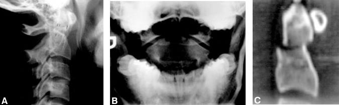 Odontoid Screw Fixation Figure 2