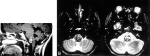 T1-weighted sagittal magnetic resonance image of a medullary lesion with heterogeneous signal intensity. A rim of normal intensity tissue covered the mass posteriorly. (B) T2-weighted axial images showed that the lesion included the left lateral brain stem surface.