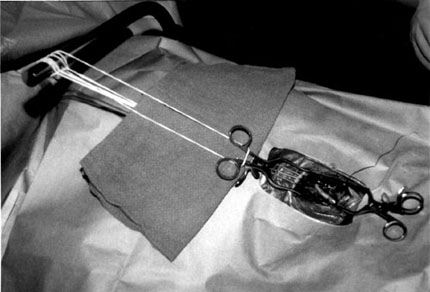 Enhancing Rostral Exposure for Carotid Endarterectomy: Technical Report Figure 2