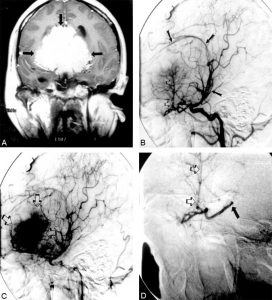 Orbital Lesions Figure 3a