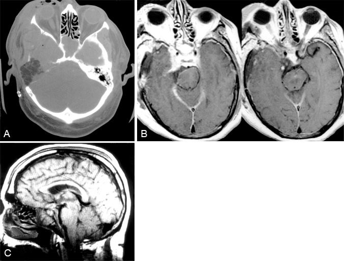 Figure 3. (A) Postoperative axial computed tomography scan shows the extent of temporal bone removal achieved with the transcochlear petrosectomy. (B) Axial and (C) sagittal T1-weighted magnetic resonance images show the extent of meningioma removal and relief of brain stem compression.