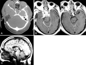 The Orbitozygomatic-Combined Supra- and Infratentorial Approach Figure 3