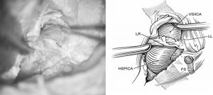 Microsurgical Anatomy of the Cavernous Sinus Figure 3