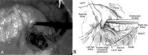 The Laparoscopic Approach for Instrumentation and Fusion of the Lumbar Spine Figure 3