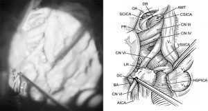 Microsurgical Anatomy of the Cavernous Sinus Figure 4