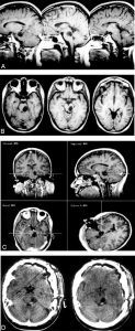The Two-Point Method: Evaluating Brain Stem Lesions Figure 4