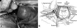 The Laparoscopic Approach for Instrumentation and Fusion of the Lumbar Spine Figure 4