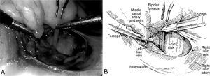 The Laparoscopic Approach for Instrumentation and Fusion of the Lumbar Spine Figure 5