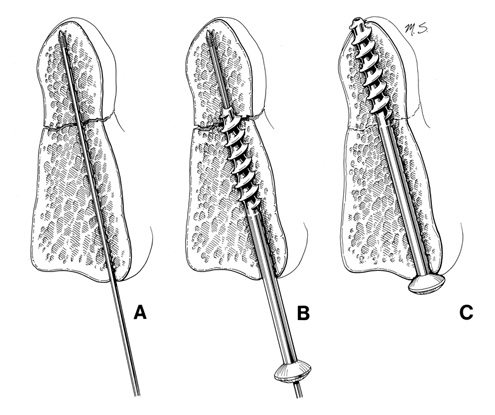 Odontoid Screw Fixation Figure 5