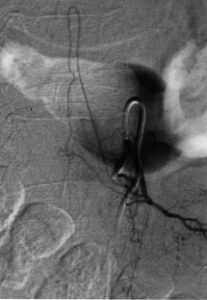 Thoracoscopic Approaches for the Treatment of Anterior Thoracic Spinal Pathology Figure 6