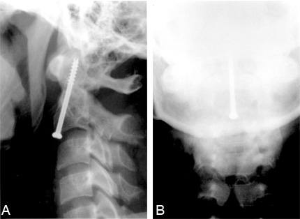 Odontoid Screw Fixation Figure 7