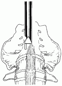 The Laparoscopic Approach for Instrumentation and Fusion of the Lumbar Spine Figure 8