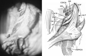Microsurgical Anatomy of the Cavernous Sinus Figure 8