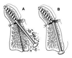 Odontoid Screw Fixation Figure 9