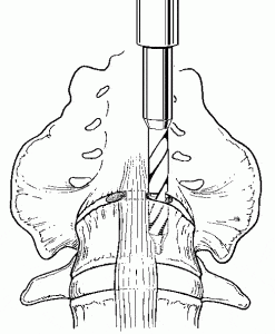The Laparoscopic Approach for Instrumentation and Fusion of the Lumbar Spine Figure 9