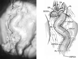 Microsurgical Anatomy of the Cavernous Sinus Figure 2