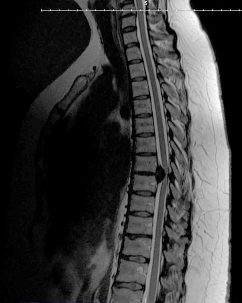 An MRI showing a herniated thoracic disc compressing the spinal cord.