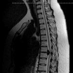 postoperative thoracic spine mri