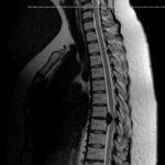 postoperative thoracic spine mri