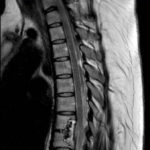 postoperative thoracic spine mri