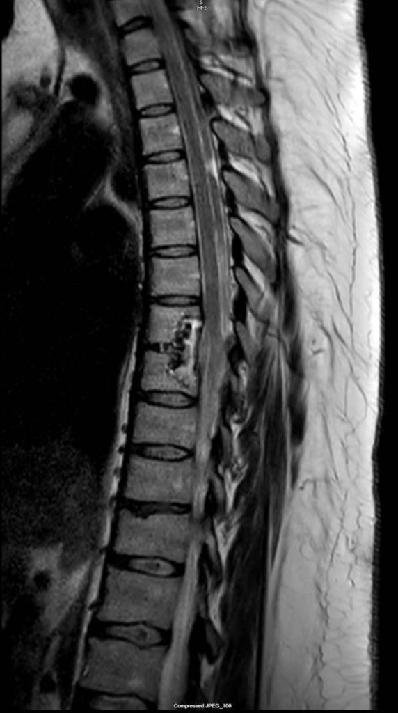 Postoperative MRI showing a repaired herniated thoracic disc