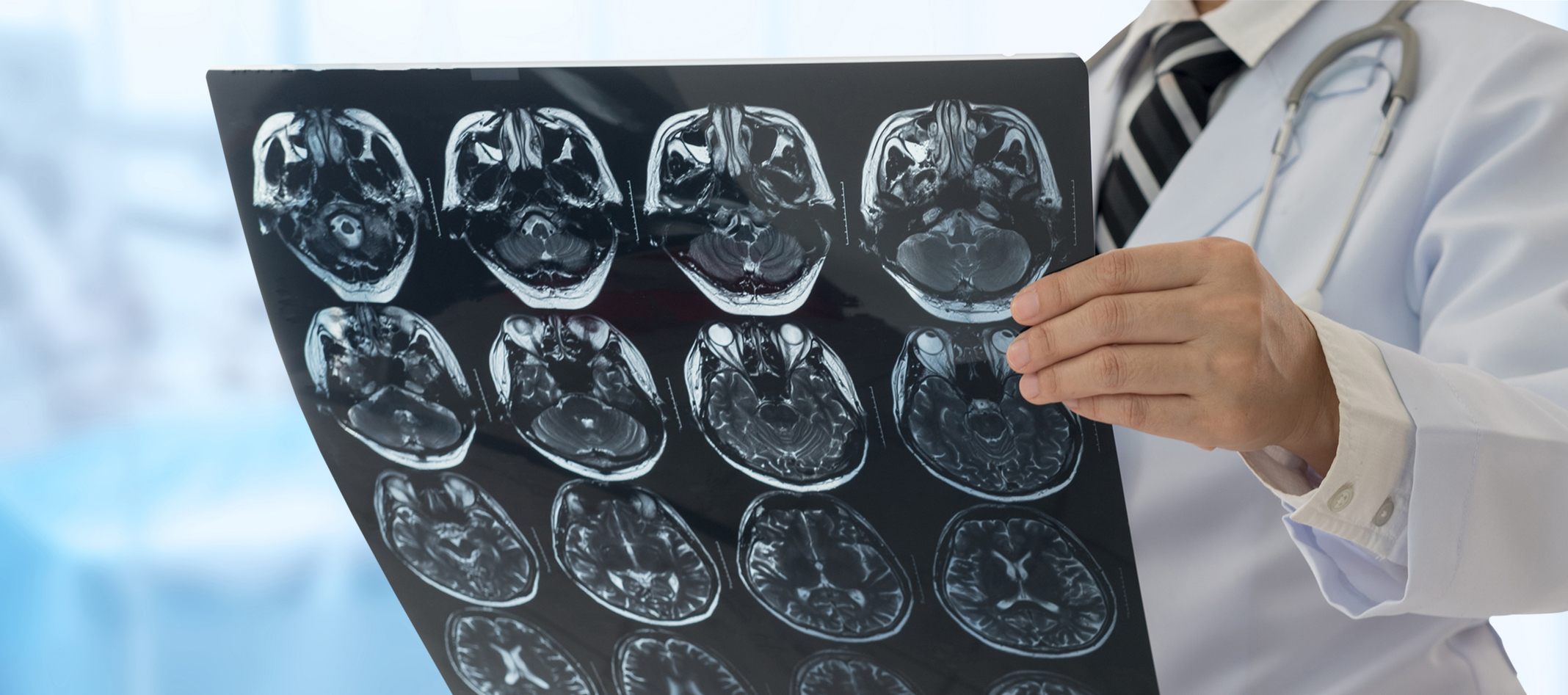 Stereotactic Laser Ablation | Hypothalamic Hamartoma Program