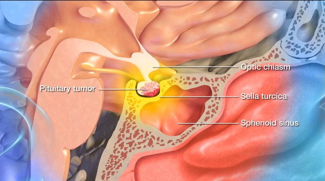 diagram showing a pituitary tumor growing on the pituitary gland
