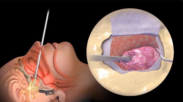 illustration showing a brain tumor being removed using endoscopic transsphenoidal surgery