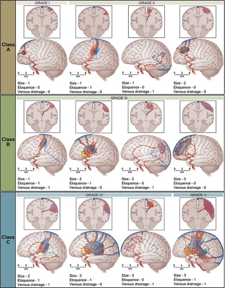 an illustration of the different Spetzler Martin grade arteriovenous malformations in the brain.