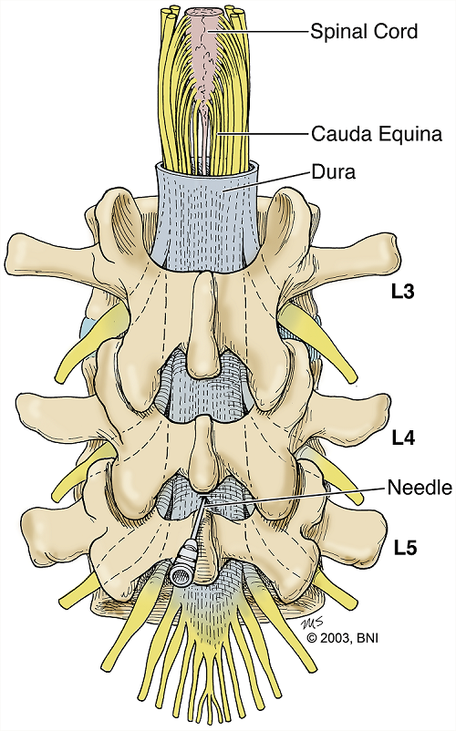 illustration showing a lumbar puncture needle entering the thecal sac between the fourth and fifth lumbar vertebrae. The dura, spinal cord, and cauda equina are also shown.