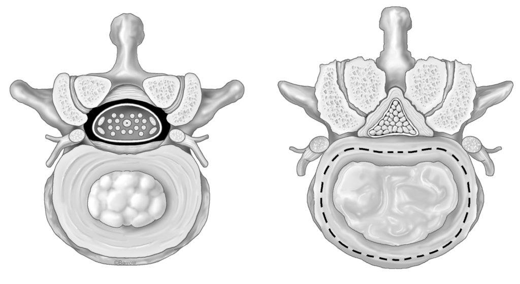 normal and healthy lumbar vertebra is shown on the left, and a degenerated disc with associated lumbar stenosis is shown on the right