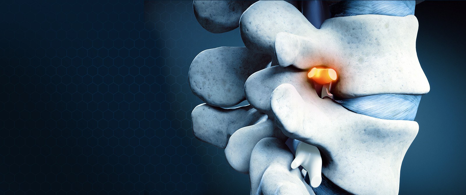 image highlighting damage in a vertebrae