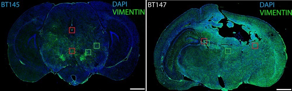 Model of OLIG2 phosphorylation-dependent glioma invasion. Our results suggest that when OLIG2 is phosphorylated at the N-terminus, TGFβ2 expression is suppressed and cells are less invasive. Unphosphorylated OLIG2 triggers expression of TGFβ2, which then associates with TGFβR1/2, resulting in phosphorylation and nuclear localization of SMAD2 and eventual increase in invasion.