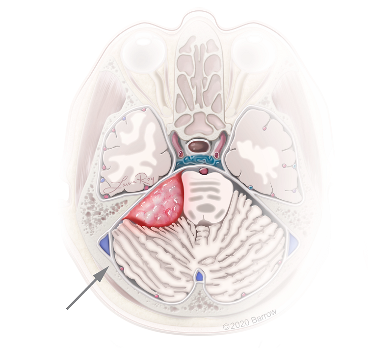 illustration of a meningioma growing on the tentorium, near the cerebellum