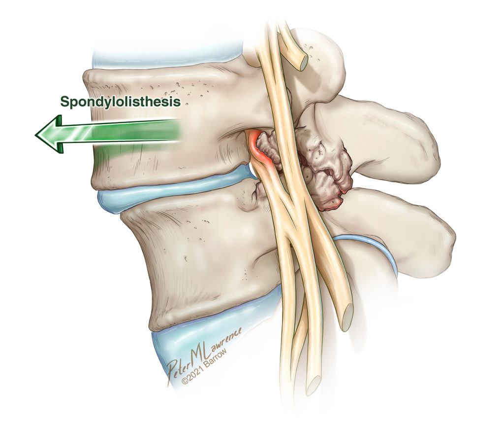 in spondylolisthesis the vertebra slips forward over the vertebra below it, putting pressure on the nerve roots exiting the spinal cord at that level of the spine