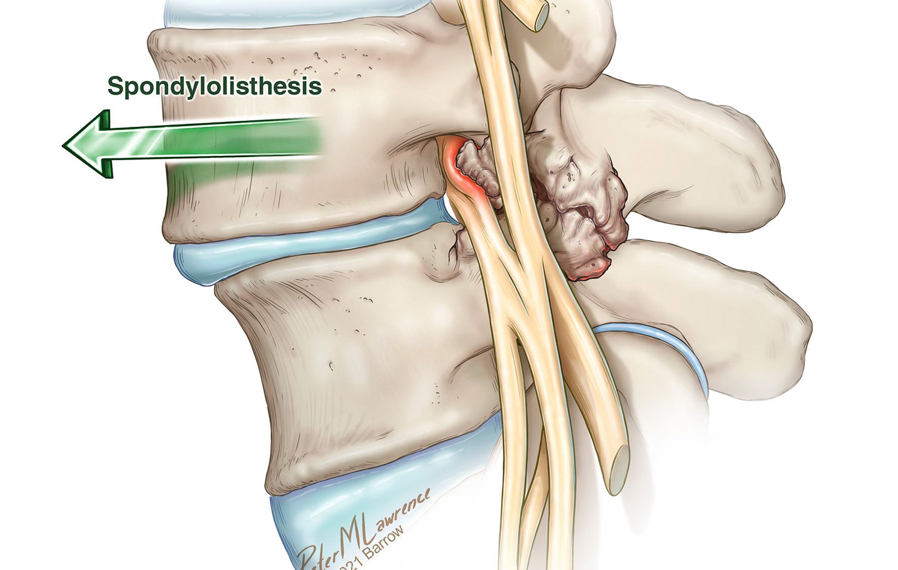 in spondylolisthesis the vertebra slips forward over the vertebra below it, putting pressure on the nerve roots exiting the spinal cord at that level of the spine