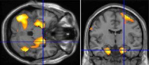 Functional magnetic resonance imaging study of a normal brain, with activation of mesial temporal structures with memory task.