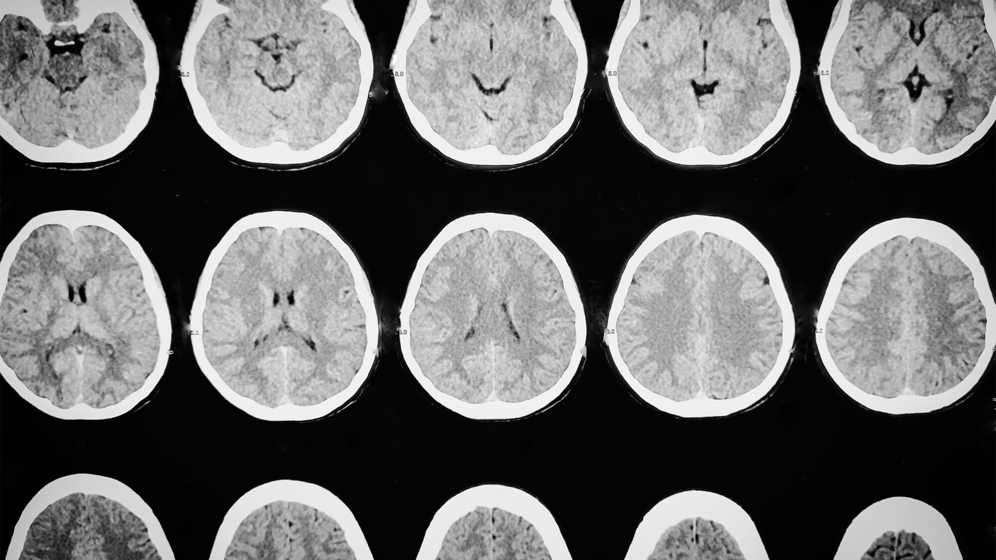 Sample image showing a computed tomographic (CT) scan of the brain.