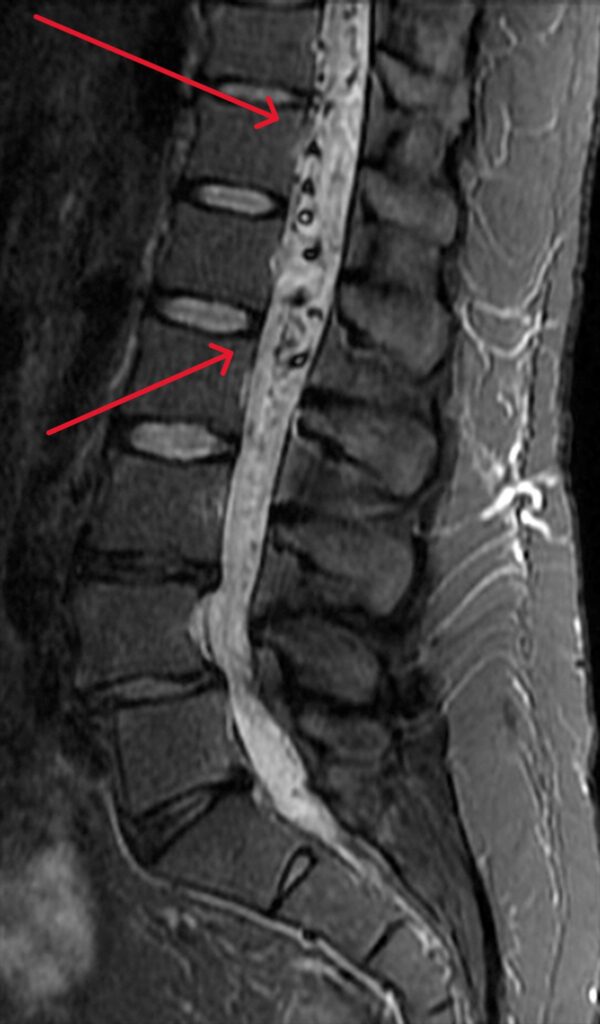 An MRI showing an arteriovenous malformation (AVM) in the thoracic region of the spinal cord. The AVM is seen as the areas of contrasting light and dark tissues between within the spinal cord.