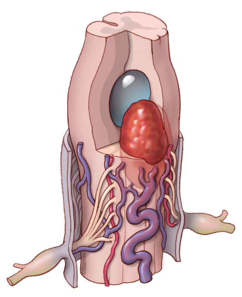 common disorders of the spinal cord