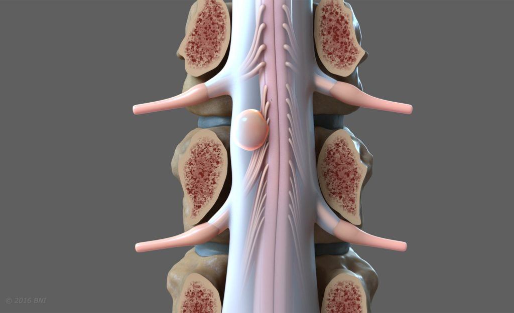 illustration showing a spinal cord tumor