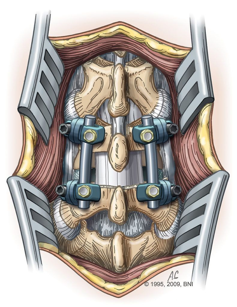 this illustration shows a single-level spinal fusion using rods and screws