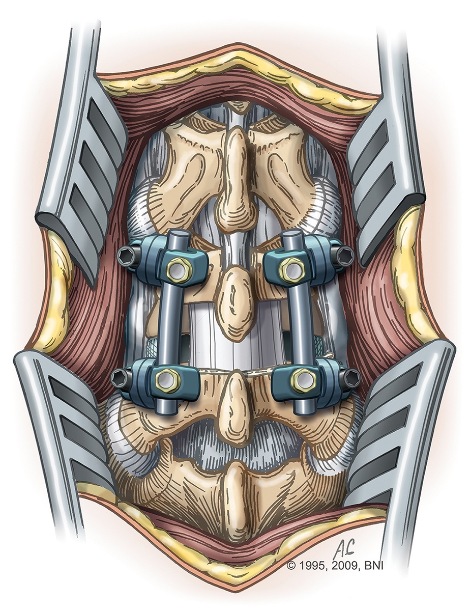 Lumbar Spinal Stenosis  Barrow Neurological Institute
