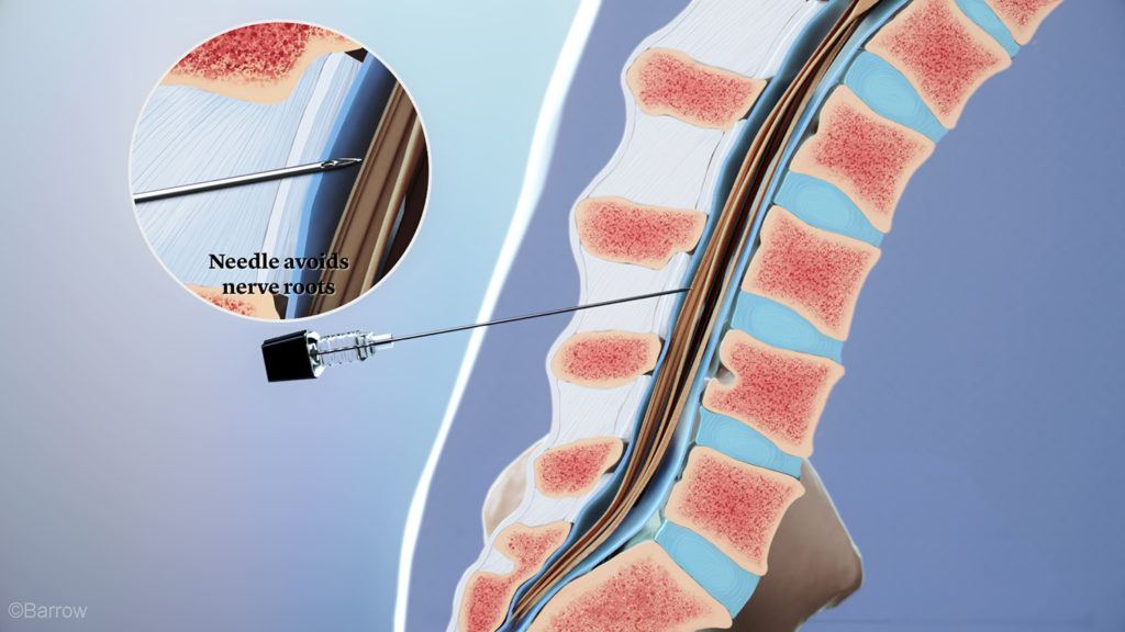 illustration of a spinal injection