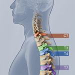 thoracic discectomy illustration